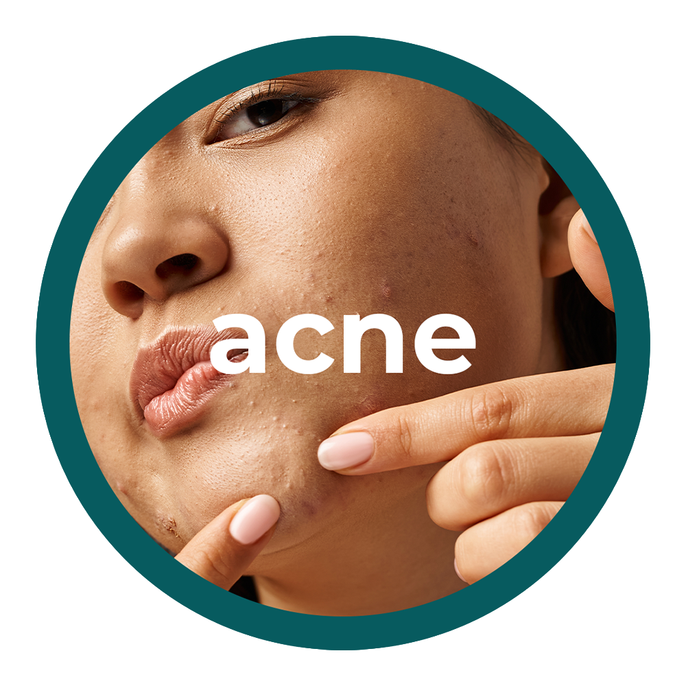 Acne
